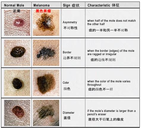 頭上有肉痣|痣也可能会癌变！长在 3 个地方要注意